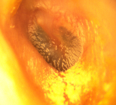 couleur orange cure oreille nettoyage oreille otoscope bougie